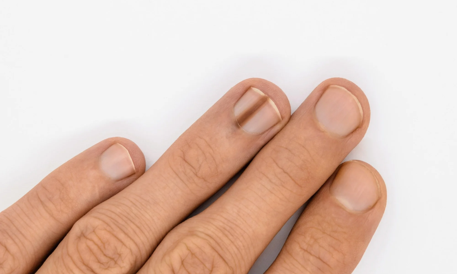 Masz taką kreskę na paznokciu? Może zwiastować chorobę