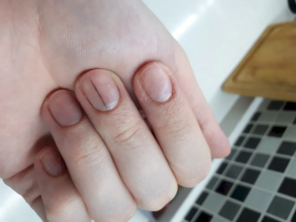 Masz taką kreskę na paznokciu? Może zwiastować chorobę