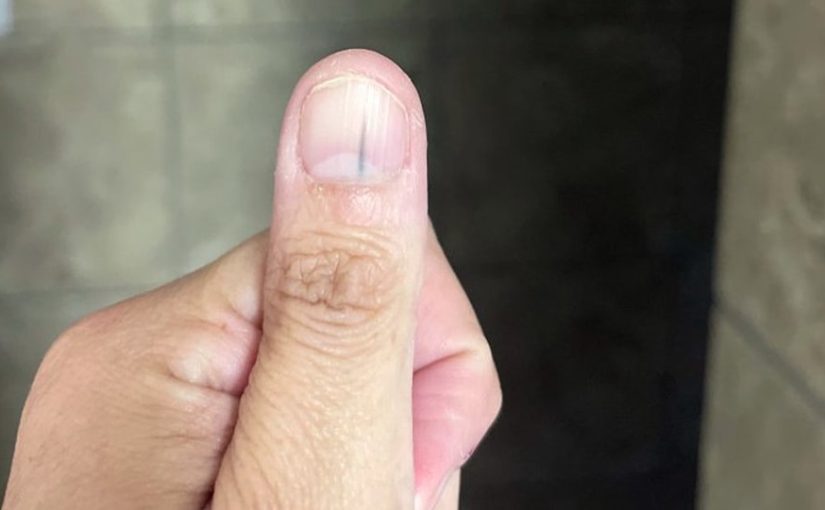 Masz taką kreskę na paznokciu? Może zwiastować chorobę ➤ haberion.com