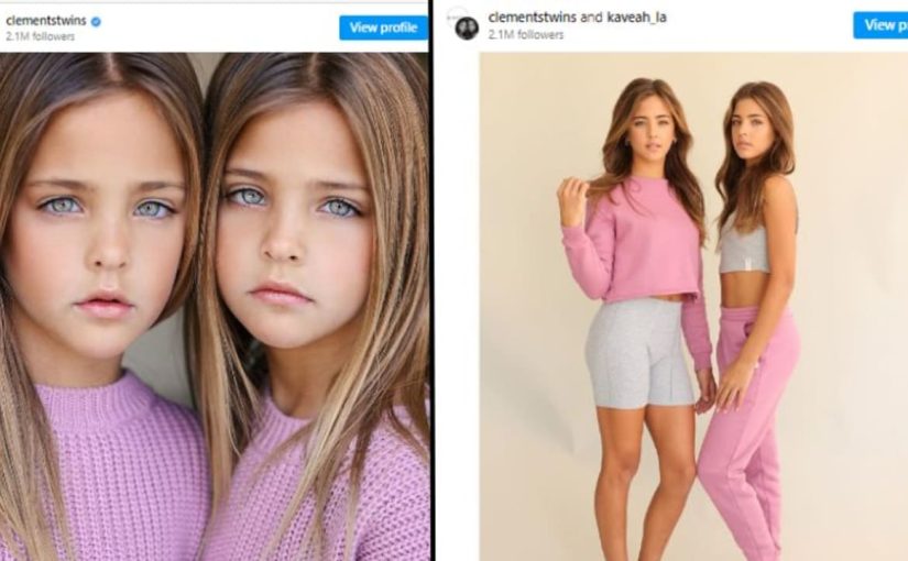 “En Güzel İkizler” Büyüdü – Bugün Hayatlarına Bakın! ➤ haberion.com