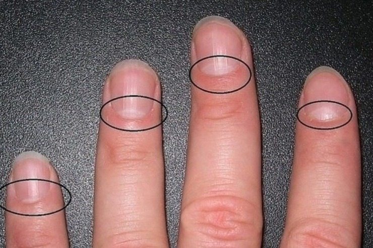 看看你的指甲：一個重要的訊號