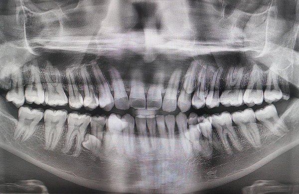 A Malaysian man was found to have 42 teeth—ten more than the average person