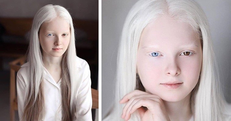 The rarest human genetic traits and their likelihood