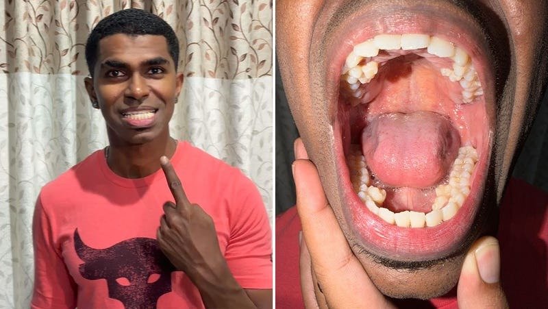 A Malaysian man was found to have 42 teeth—ten more than the average person ➤ haberion.com