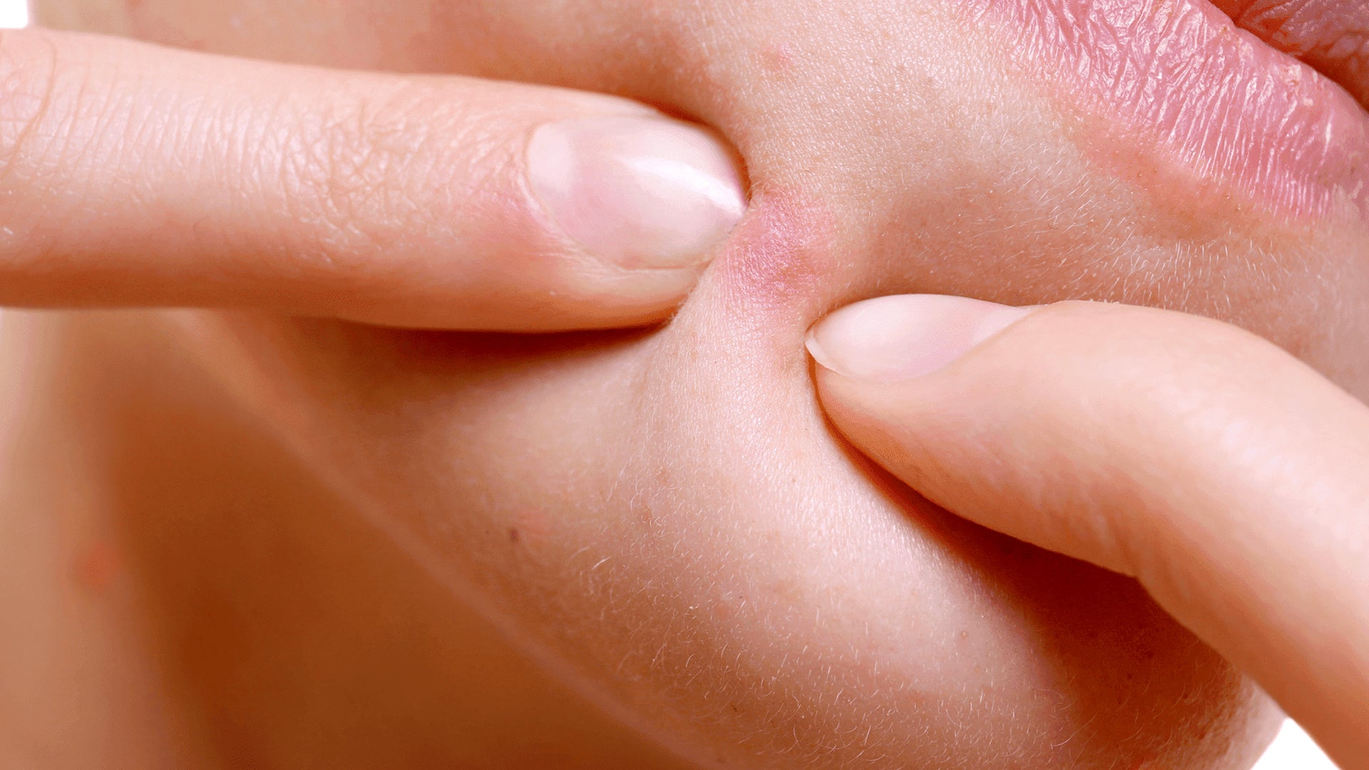 She Popped A Simple Pimple And Filmed The Horrifying Result