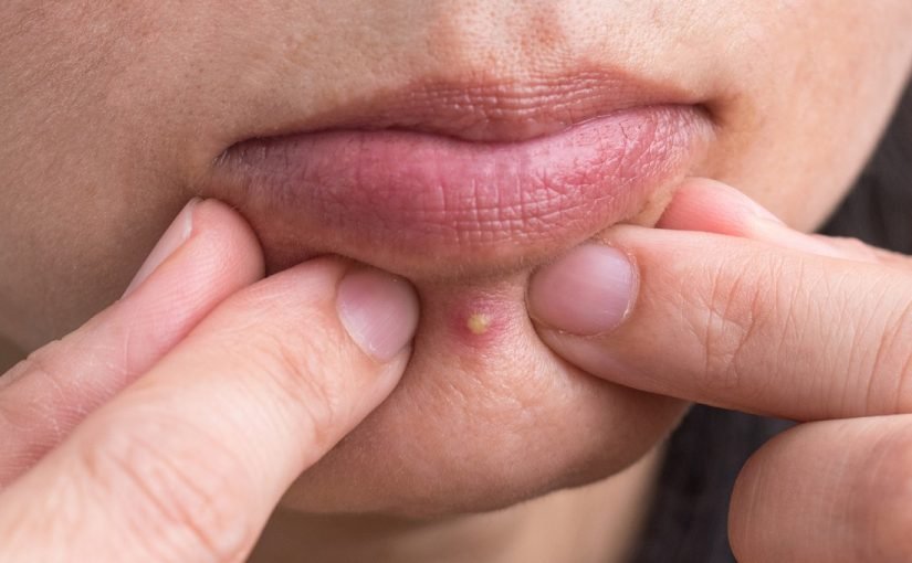 She Popped A Simple Pimple And Filmed The Horrifying Result ➤ haberion.com