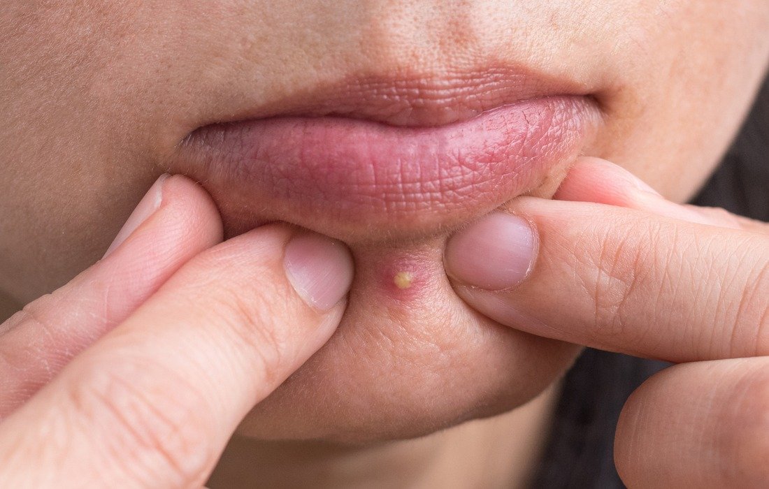 She Popped A Simple Pimple And Filmed The Horrifying Result ➤ Главное.net