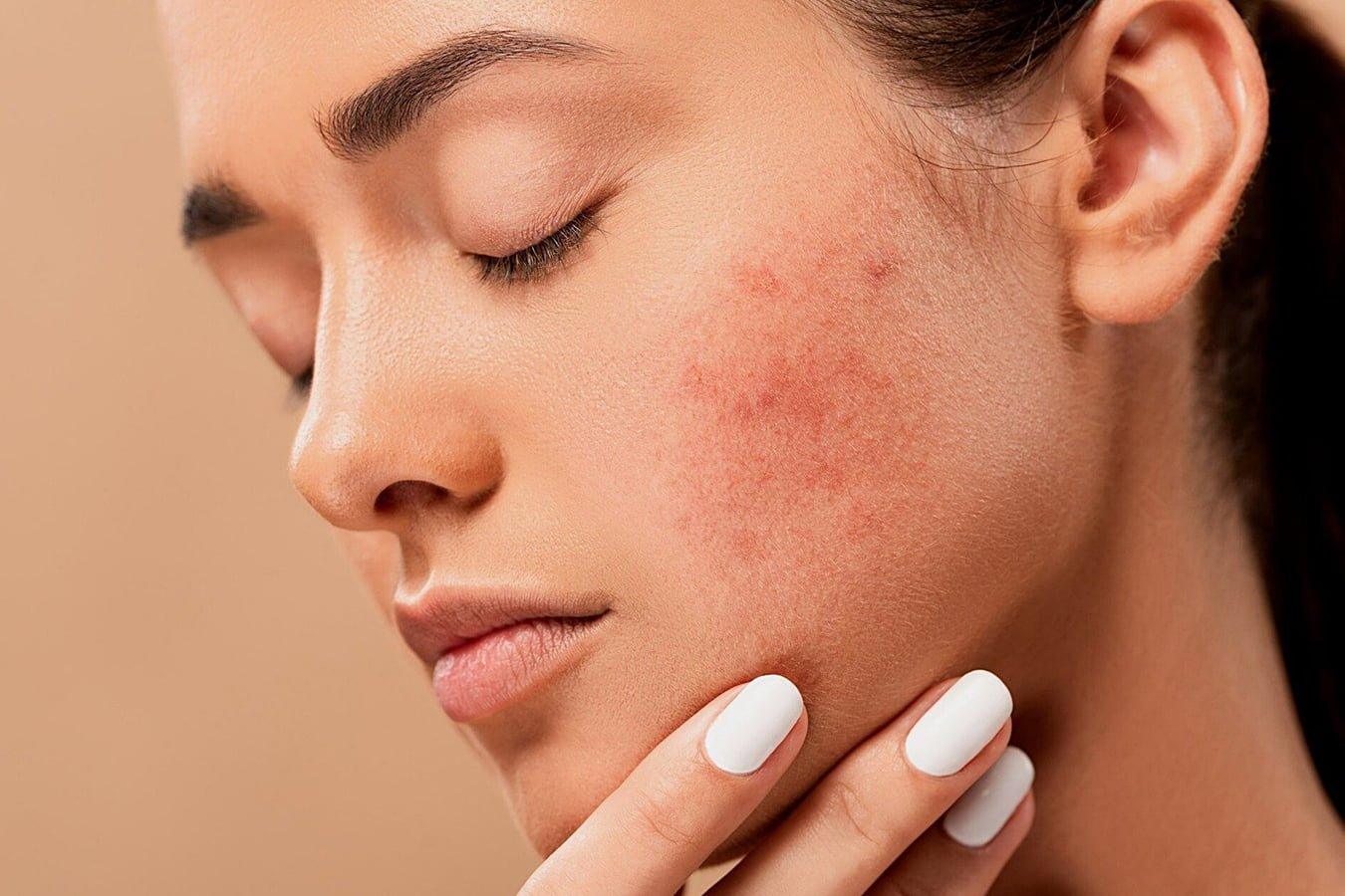 She Popped A Simple Pimple And Filmed The Horrifying Result