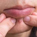 평범한 여드름인 줄 알고 짰다가… 카메라에 담긴 충격적인 결과 ➤ haberion.com